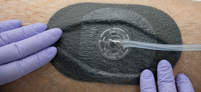 کاپ سنسور وکیوم تراپی زخم (SPP) ECOVAC